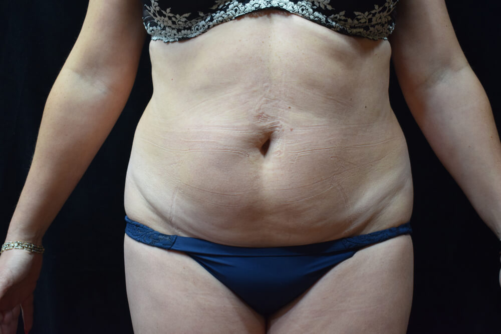 Tummy Tuck (abdominoplasty) - Dr. Joseph A. Racanelli Tummy Tuck (abdominoplasty)