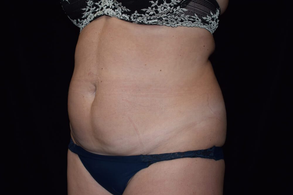 Tummy Tuck (abdominoplasty) - Dr. Joseph A. Racanelli Tummy Tuck (abdominoplasty)