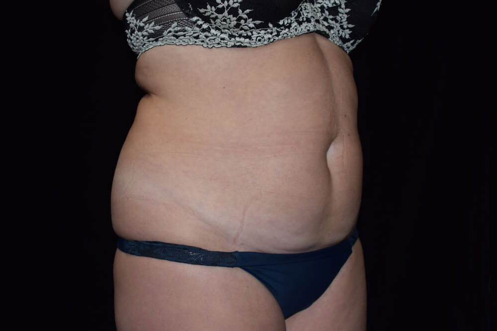 Tummy Tuck (abdominoplasty) - Dr. Joseph A. Racanelli Tummy Tuck (abdominoplasty)