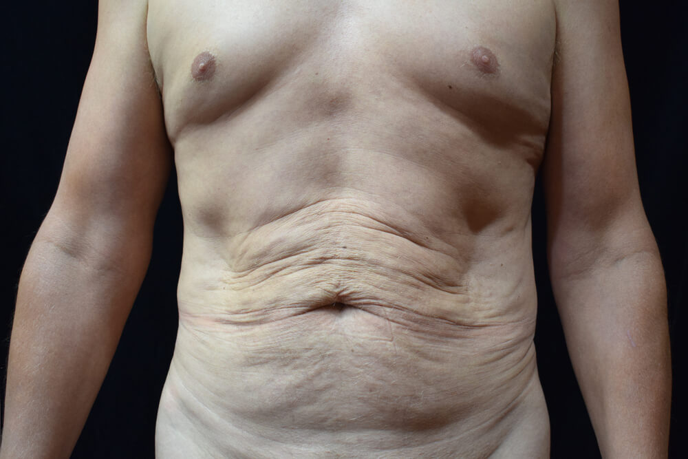 Tummy Tuck (abdominoplasty) - Dr. Joseph A. Racanelli Tummy Tuck (abdominoplasty)