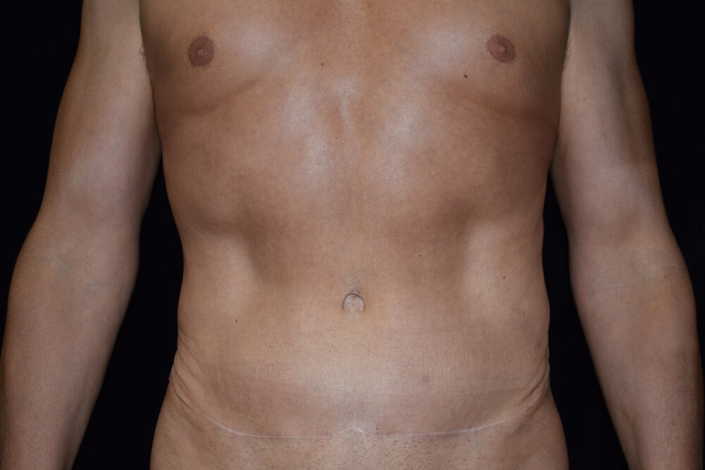 Tummy Tuck (abdominoplasty) - Dr. Joseph A. Racanelli Tummy Tuck (abdominoplasty)