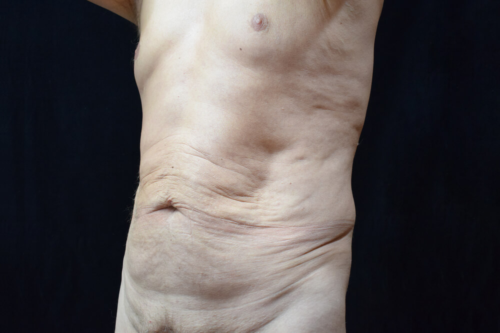 Tummy Tuck (abdominoplasty) - Dr. Joseph A. Racanelli Tummy Tuck (abdominoplasty)