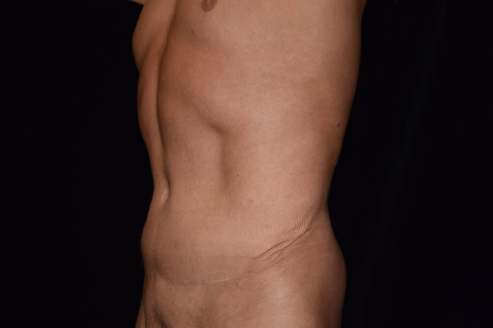Tummy Tuck (abdominoplasty) - Dr. Joseph A. Racanelli Tummy Tuck (abdominoplasty)