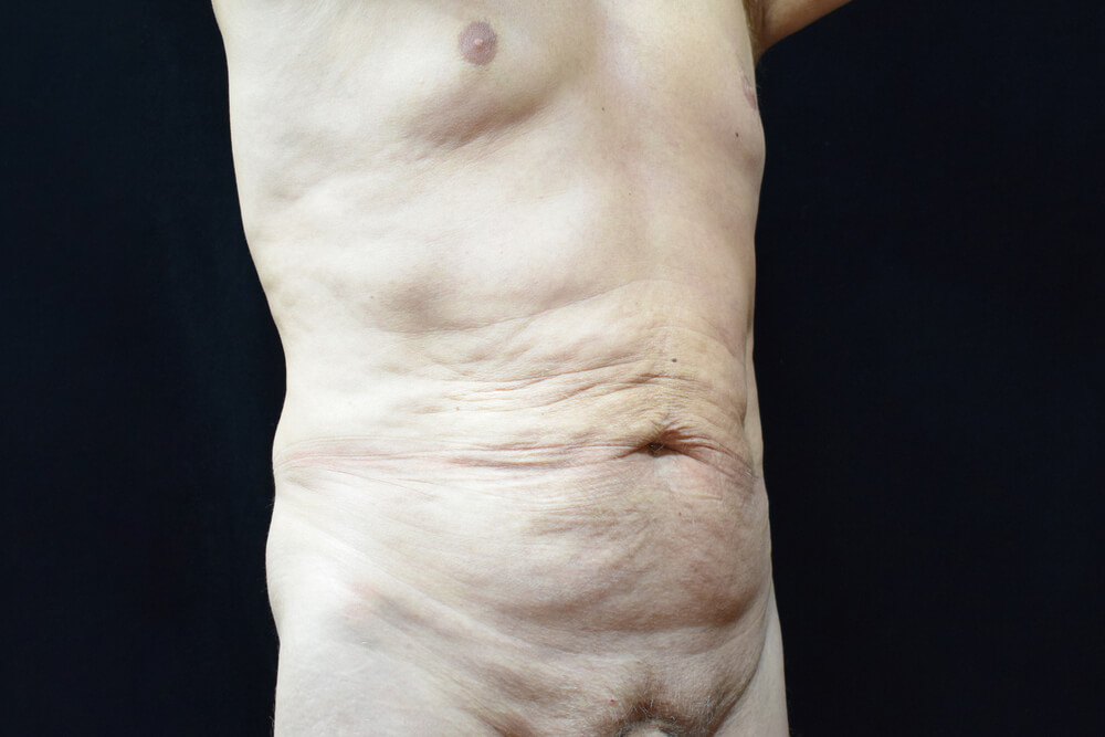 Tummy Tuck (abdominoplasty) - Dr. Joseph A. Racanelli Tummy Tuck (abdominoplasty)