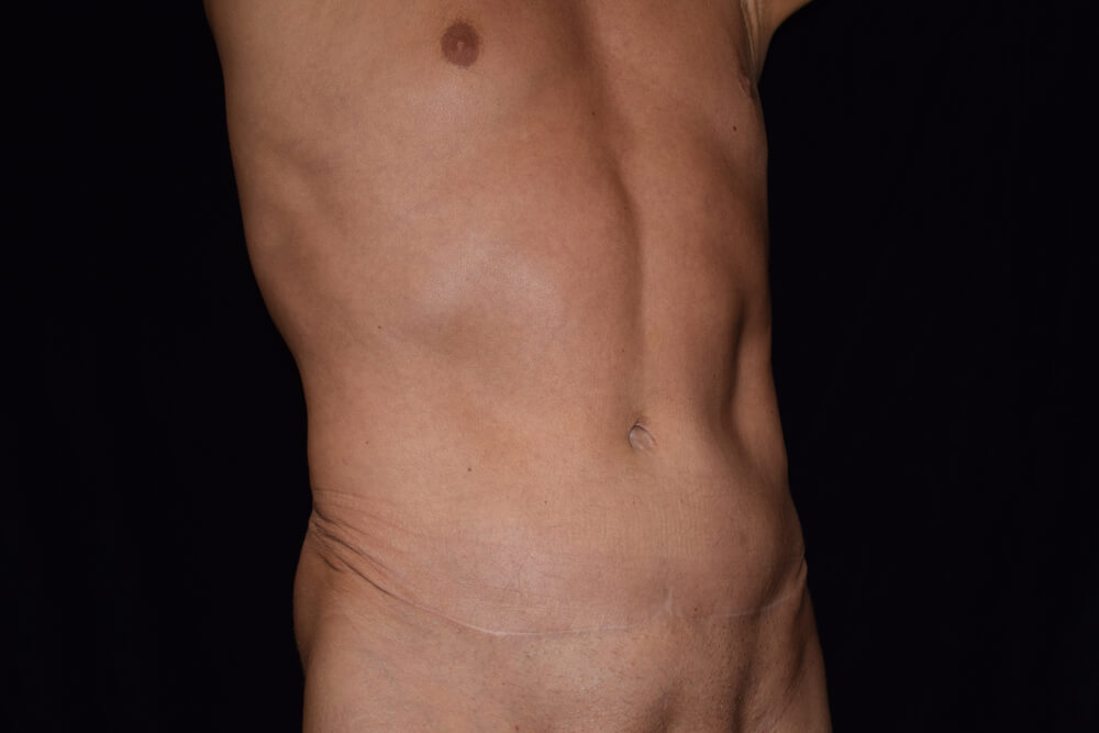 Tummy Tuck (abdominoplasty) - Dr. Joseph A. Racanelli Tummy Tuck (abdominoplasty)