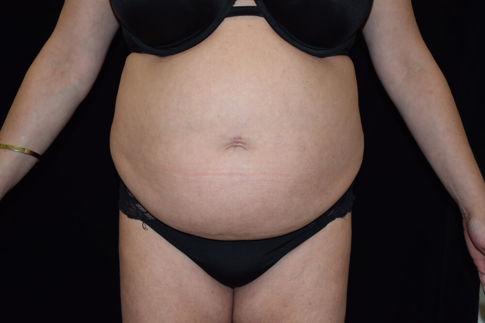 Tummy Tuck (abdominoplasty) - Dr. Joseph A. Racanelli Tummy Tuck (abdominoplasty)