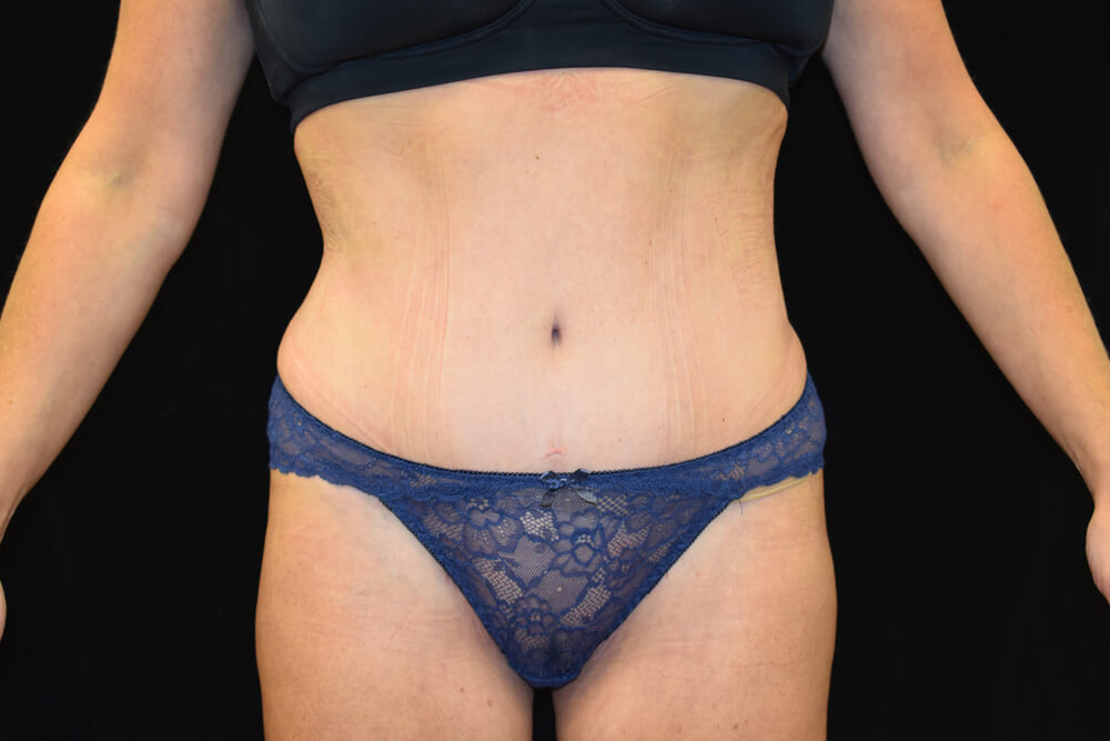 Tummy Tuck (abdominoplasty) - Dr. Joseph A. Racanelli Tummy Tuck (abdominoplasty)