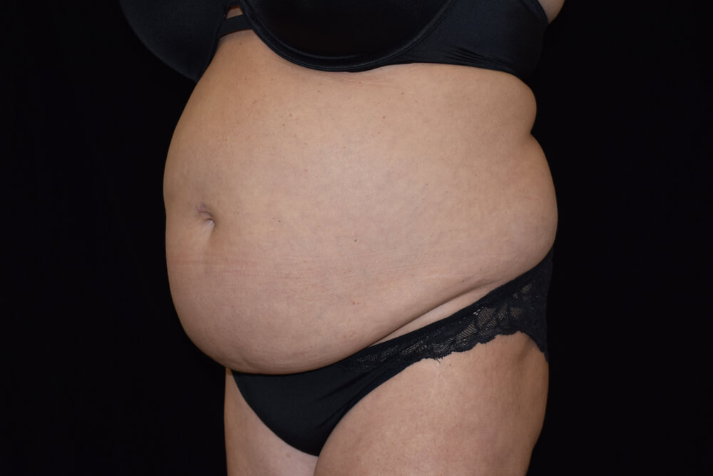 Tummy Tuck (abdominoplasty) - Dr. Joseph A. Racanelli Tummy Tuck (abdominoplasty)