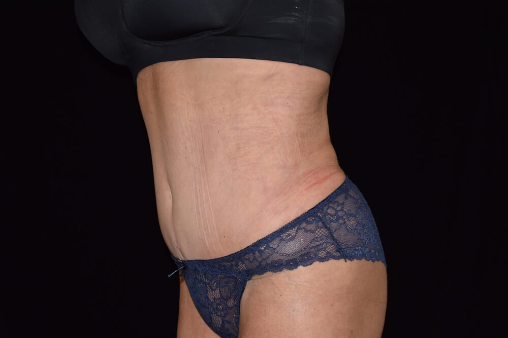 Tummy Tuck (abdominoplasty) - Dr. Joseph A. Racanelli Tummy Tuck (abdominoplasty)