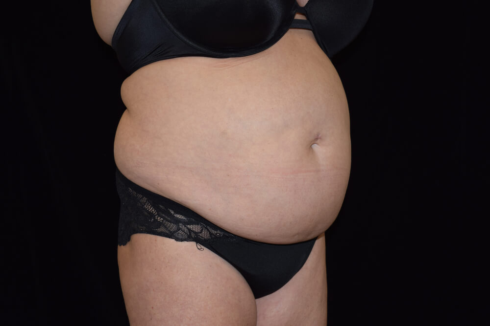 Tummy Tuck (abdominoplasty) - Dr. Joseph A. Racanelli Tummy Tuck (abdominoplasty)