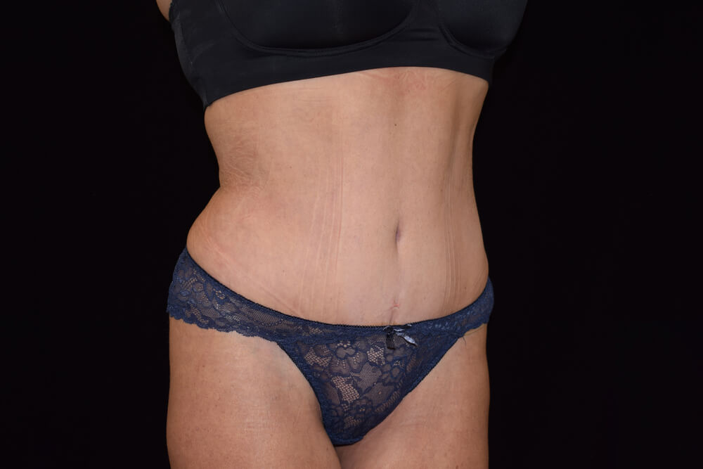 Tummy Tuck (abdominoplasty) - Dr. Joseph A. Racanelli Tummy Tuck (abdominoplasty)