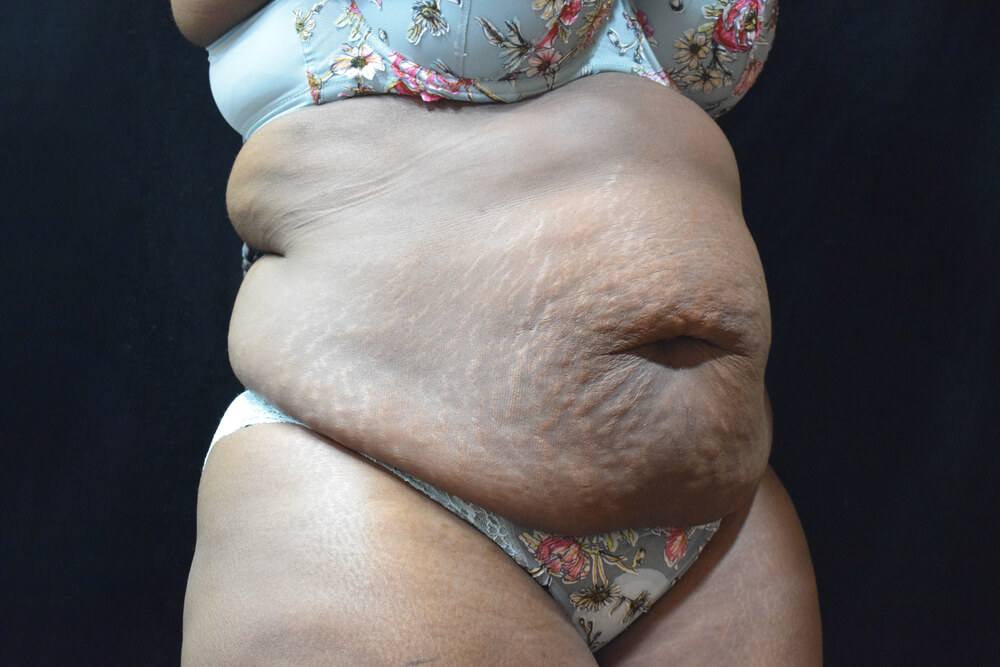 Tummy Tuck (abdominoplasty) - Dr. Joseph A. Racanelli Tummy Tuck (abdominoplasty)