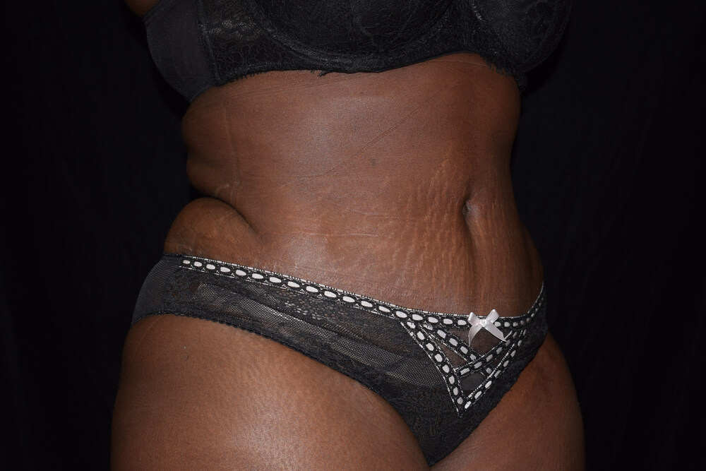 Tummy Tuck (abdominoplasty) - Dr. Joseph A. Racanelli Tummy Tuck (abdominoplasty)