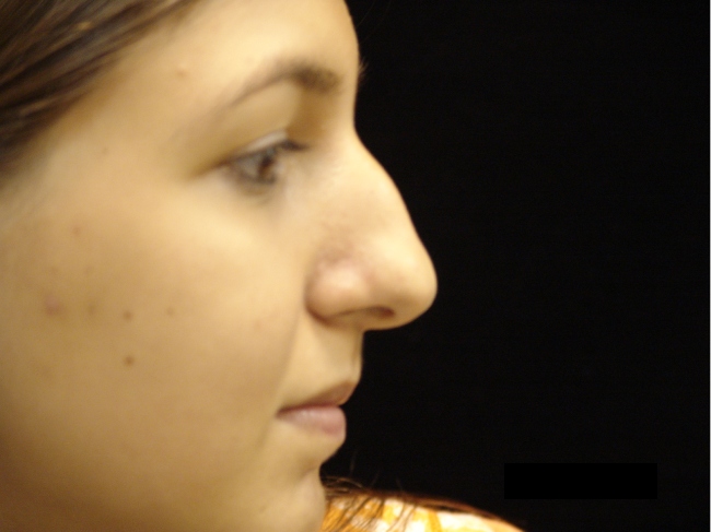 Rhinoplasty Before Photo for Patient #1195