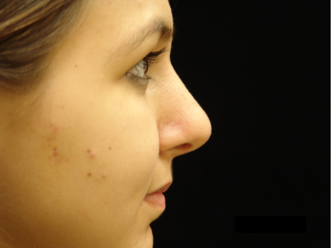 Rhinoplasty After Photo for Patient #1195