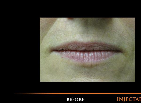 Lip Fillers Before Photo for Patient #1316