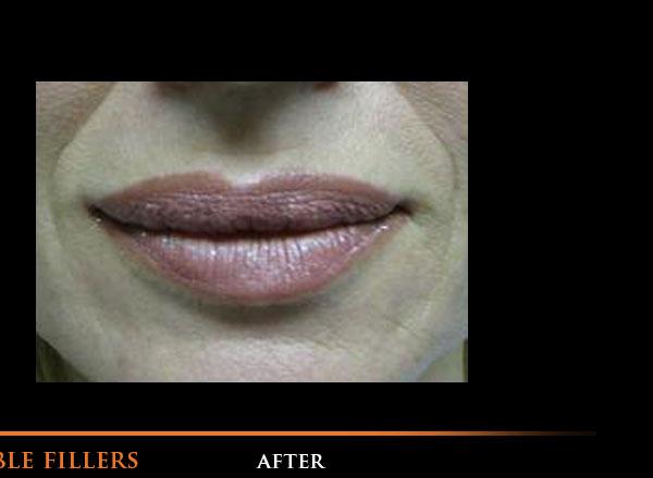 Lip Fillers After Photo for Patient #1316
