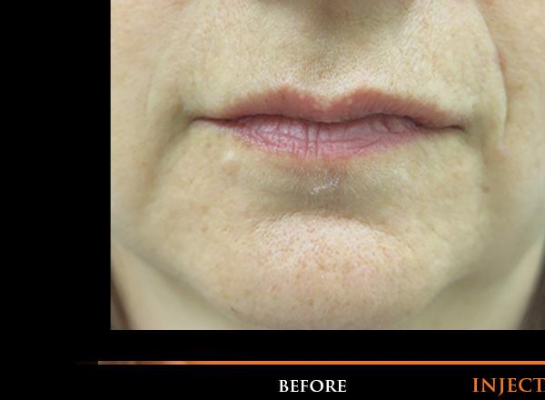 Lip Fillers Before Photo for Patient #1317