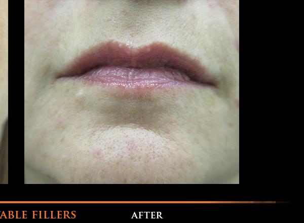 Lip Fillers After Photo for Patient #1317