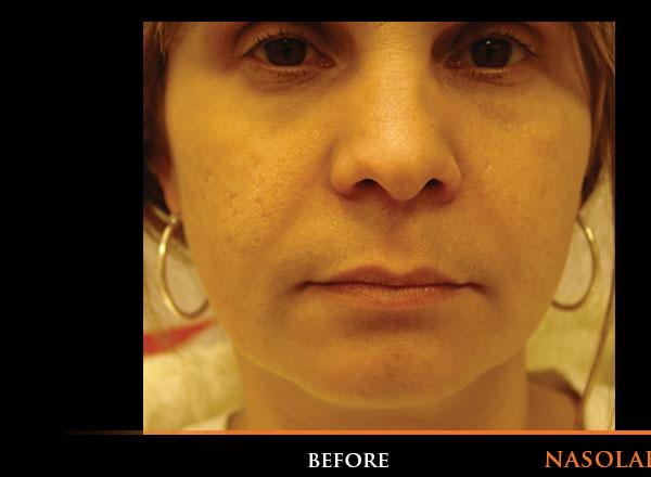 Nasolabial Folds Before Photo for Patient #1290