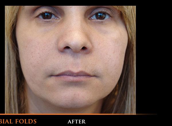 Nasolabial Folds After Photo for Patient #1290