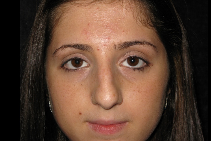 Rhinoplasty Before Photo for Patient #1196