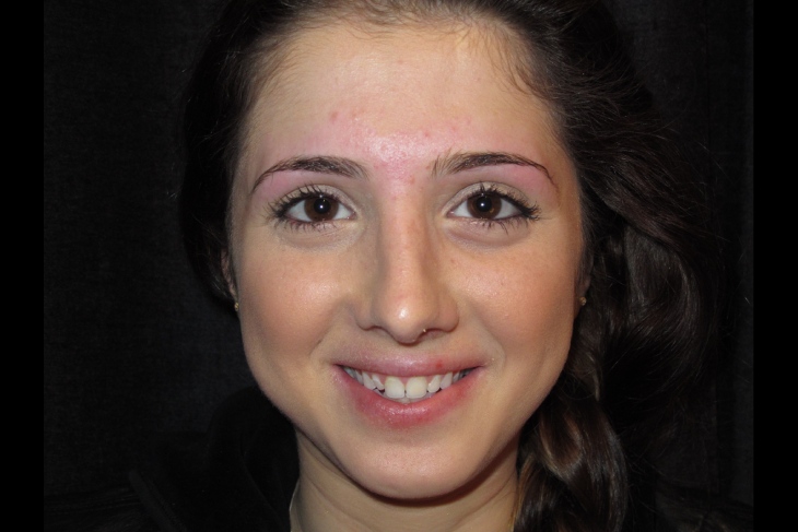 Rhinoplasty After Photo for Patient #1196