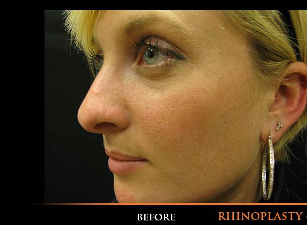 Rhinoplasty Before Photo for Patient #1197