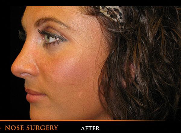 Rhinoplasty After Photo for Patient #1197