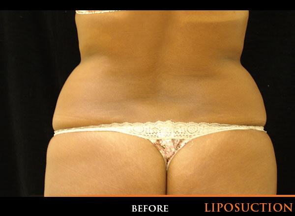 Liposuction Before Photo for Patient #1057
