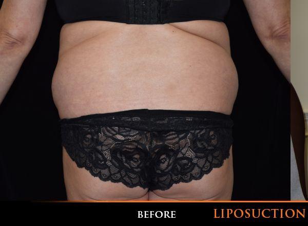 Fat Transfer Before Photo for Patient #1064