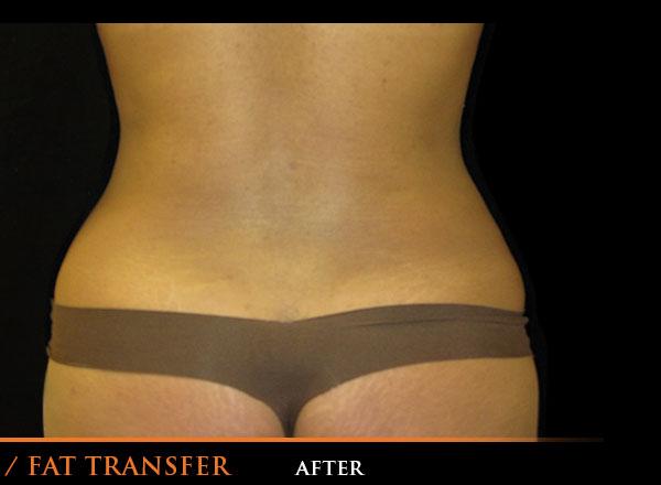 Liposuction After Photo for Patient #1057