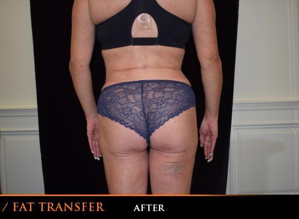Fat Transfer After Photo for Patient #1064