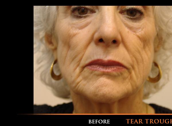 Tear Trough Before Photo for Patient #1207