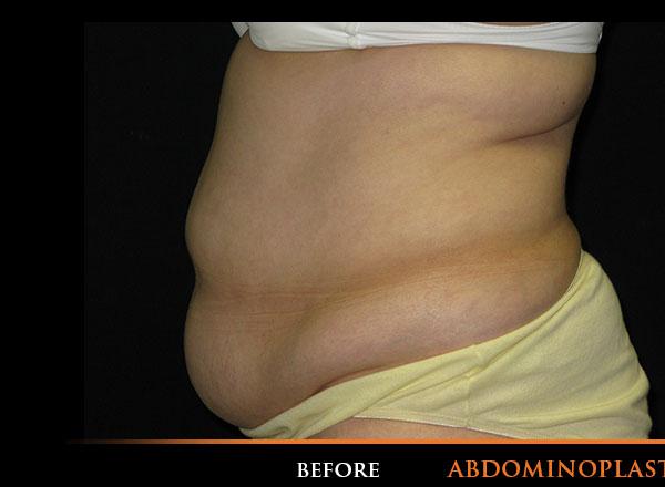 Tummy Tuck Before Photo for Patient #1881