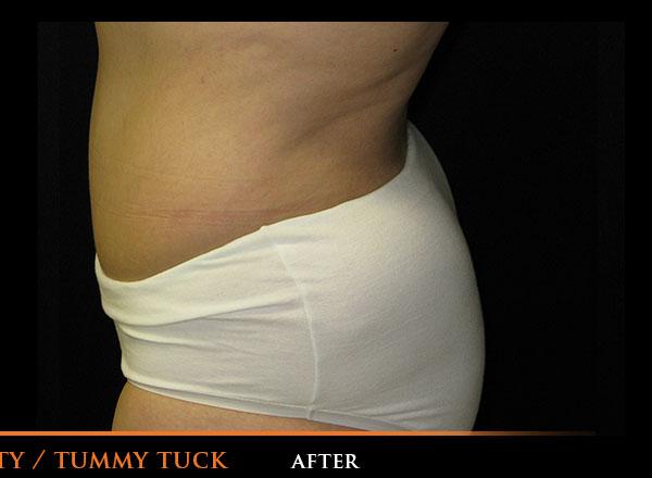 Tummy Tuck After Photo for Patient #1881