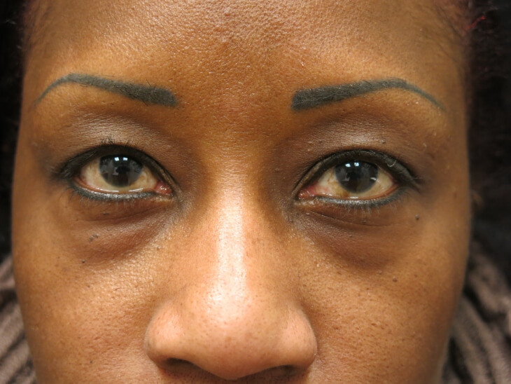 Blepharoplasty Before Photo for Patient #3176