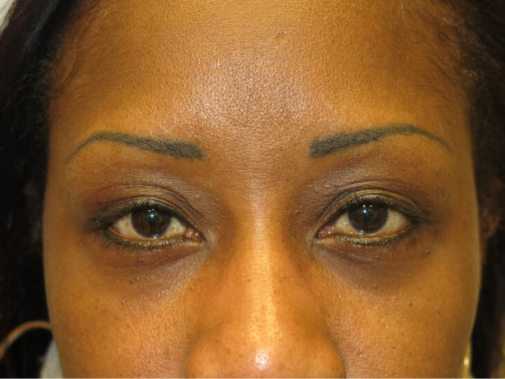 Blepharoplasty After Photo for Patient #3176