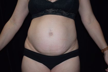 Tummy Tuck Before & After Patient #3263
