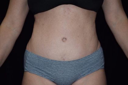 Tummy Tuck Before & After Patient #3263