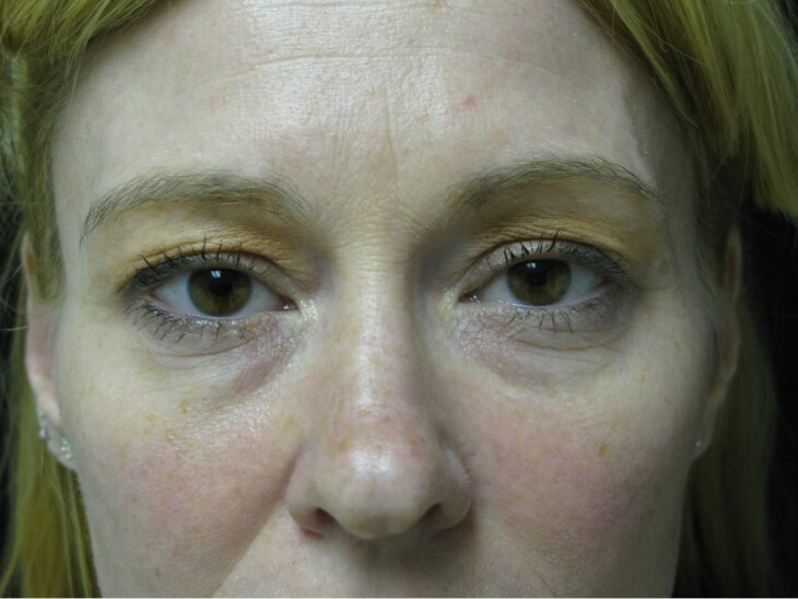 Blepharoplasty Before Photo for Patient #3175