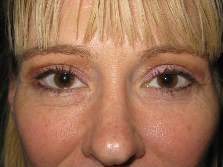 Blepharoplasty After Photo for Patient #3175