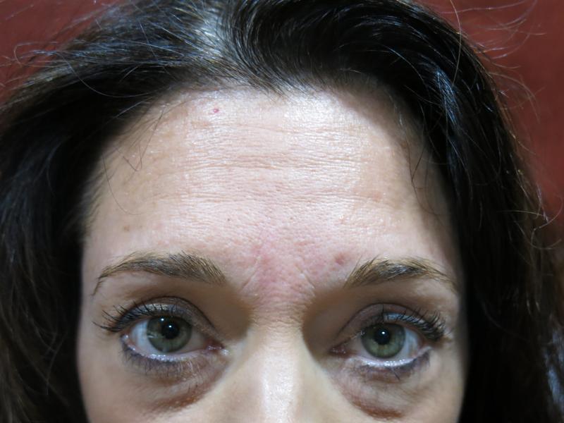 Botox Before Photo for Patient #1261