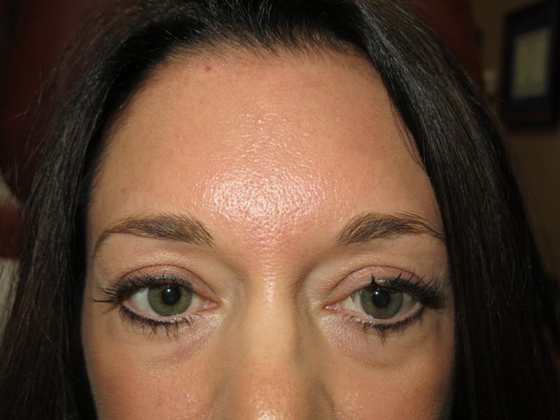 Botox After Photo for Patient #1261