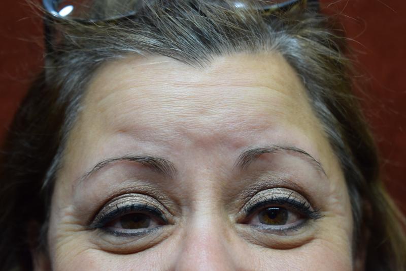 Botox Before Photo for Patient #1259