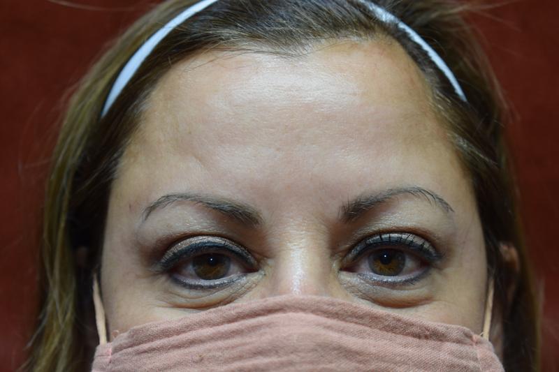 Botox After Photo for Patient #1259