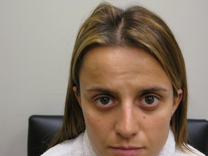 Botox Before Photo for Patient #1262