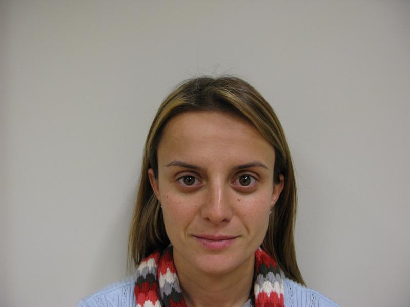 Botox After Photo for Patient #1262
