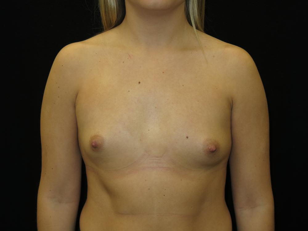 Breast Augmentation Before Photo for Patient #3101