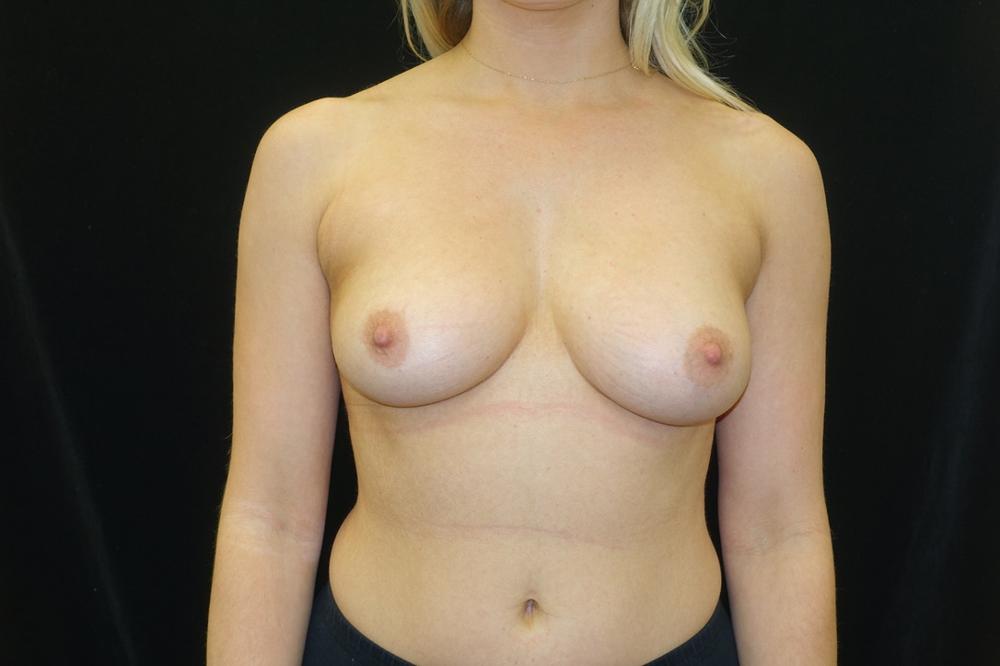 Breast Augmentation Before Photo for Patient #3103